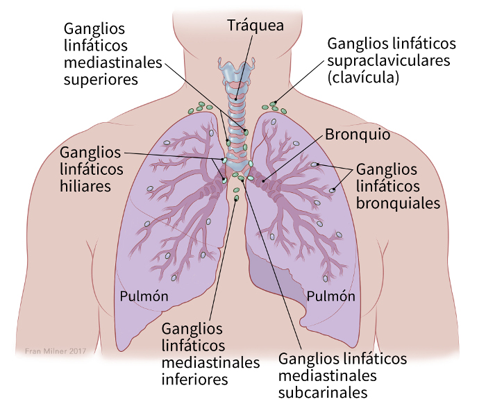illustration showing the lungs, hilar lymph nodes, upper mediastinal lymph nodes, bronchial lymph nodes, bronchus, trachea, supraclavicular (collarbone) lymph nodes, lower mediastinal lymph nodes and subcarinal mediastinal lymph nodes