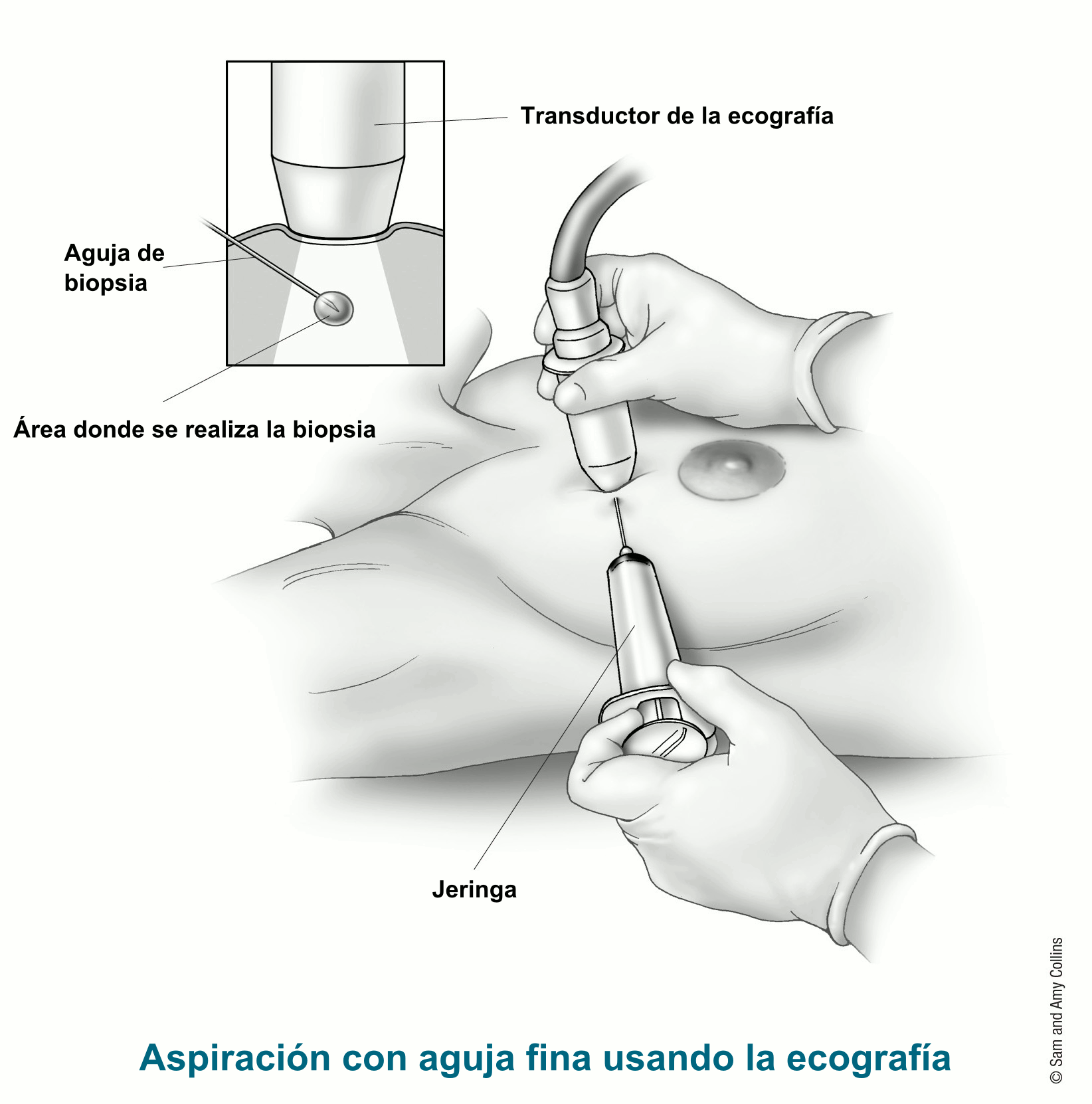 Ilustración de aspiración con aguja fina usando la ecografía