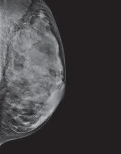 mammogram image showing a breast that is extremely dense, which makes it hard to see tumors in the tissue