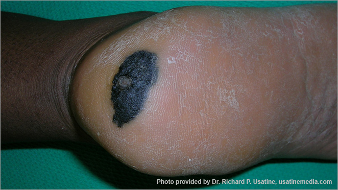 Melanoma on the heel of the foot, appearing on dark skin as a large, dark, asymmetrical area with a jagged border.